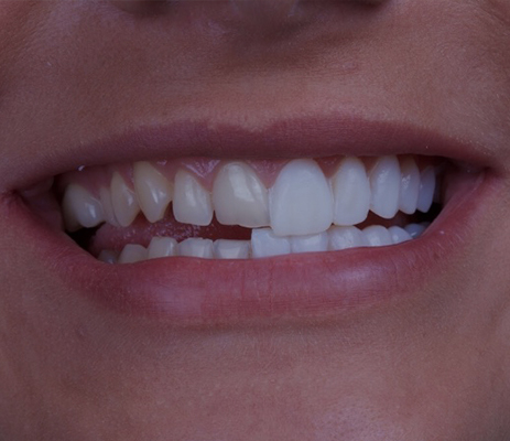 Studio Dentistico Pavanello | faccette dentali