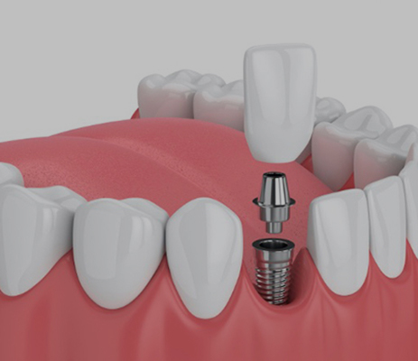 Studio Dentistico Pavanello | impianto-dentale