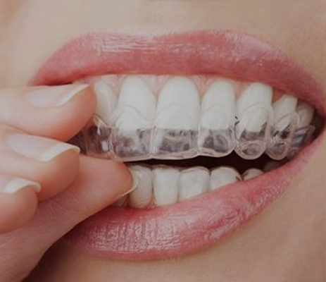 Studio Dentistico Pavanello | Ortodonzia Trasparente