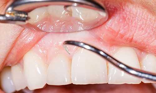 Studio Dentistico Pavanello | Parodontite